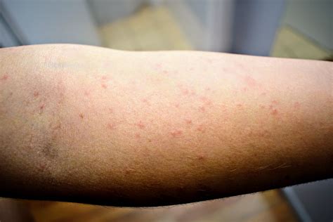early scabies rash