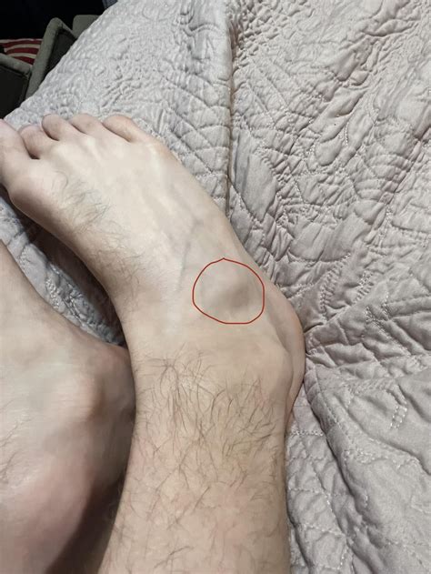 Bone (?) on right ankle protruding much farther than left ankle