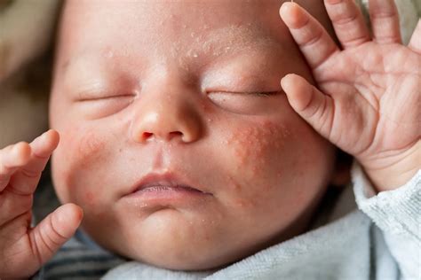 baby acne lifemd