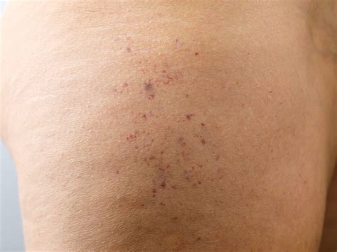 what causes broken blood vessels on face 6