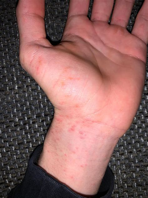 Habe am ganzen Körper Juckreiz? (Juckreiz am Körper)