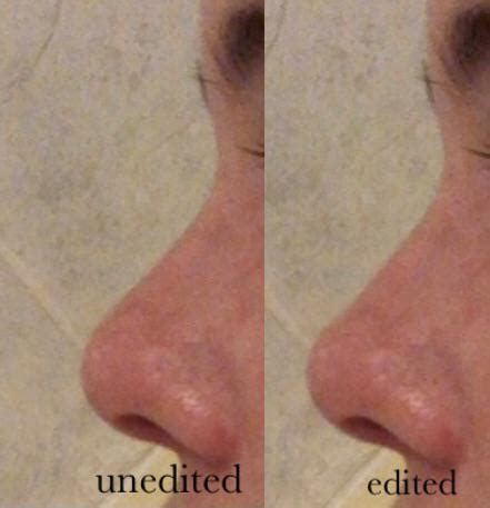 mild polly beak deformity after 2 rhinos? it was fixed in both ...
