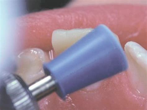 Cosmedent FlexiCups & FlexiPoints – Clinical Research Dental