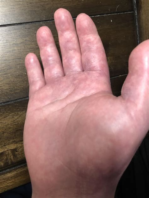 122 best r/crps images on Pholder | So sick of people telling me my