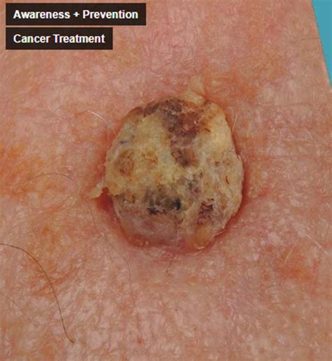 Symptoms of Basal Cell Carcinoma