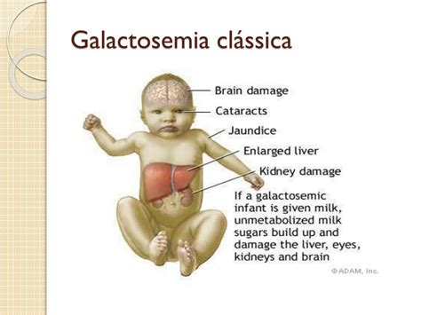 galactosemia powerpoint    id