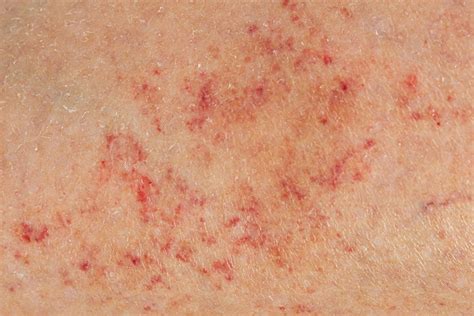 Petechiae: Causes, Treatment & When to See a Doctor | MyVision.org