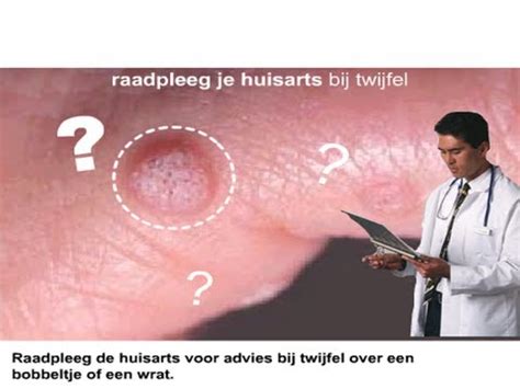 Wratten - Wat zijn het en hoe kun je ze verwijderen? - YouTube