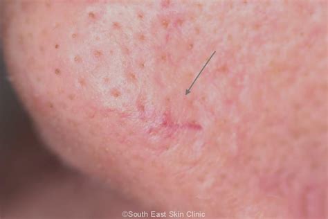 BCC (Basal Cell Carcinoma)
