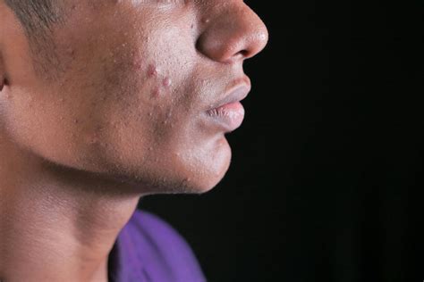 DIY Natural Remedies for Atopic Dermatitis - QualityHow