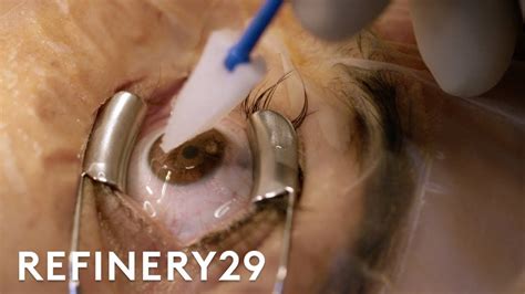 Eye Laser Surgery Procedure