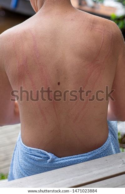 Dermatographic Urticaria Known Dermographism Dermatographism Skin Stock ...