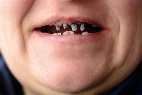 Rotten Teeth Stock Photos, Images and Backgrounds for Free Download