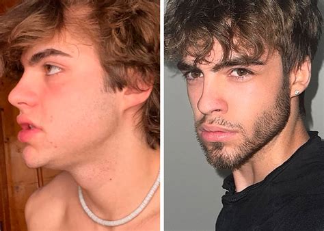 bone smashing  chin extensions