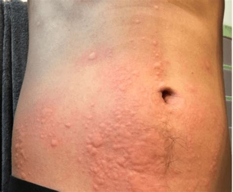 The Burden Of Sweat Rash Or Exercise Induced Rashes – The Standard ...