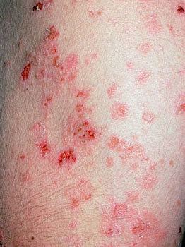 Foliaceu Pemphigu Skin Disease