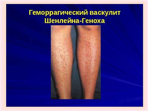 Системные васкулиты - презентация онлайн