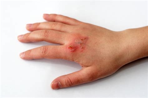 infected wounds     doctor suncoast urgent care