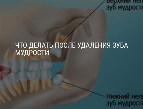 Что делать после удаления зуба мудрости: обработка лунки после удаления ...