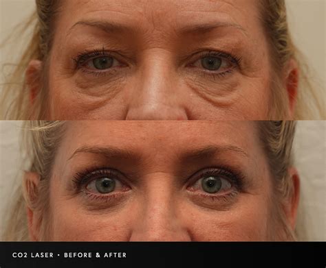 laser skin resurfacing scottsdale dr grant moore