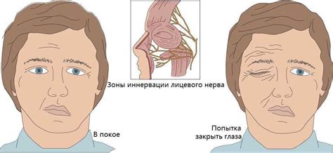 Неврит лицевого нерва. Лечение и симптомы воспалённого лицевого нерва.
