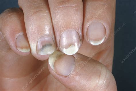 Onycholysis of the fingernails - Stock Image - C049/4521 - Science ...