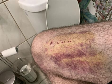 Update to thigh bruise : r/bruises