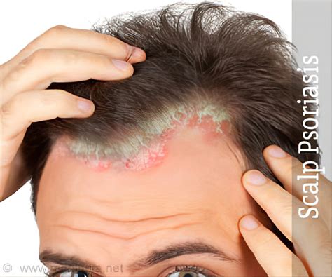 Psoriasis Scalp