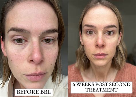 bbl laser    gurl  green