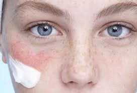 treat skin rash  face rash