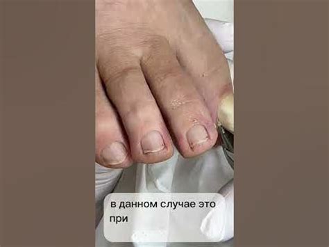 ПРИЧИНЫ СКРУЧИВАНИЯ НОГТЯ - YouTube