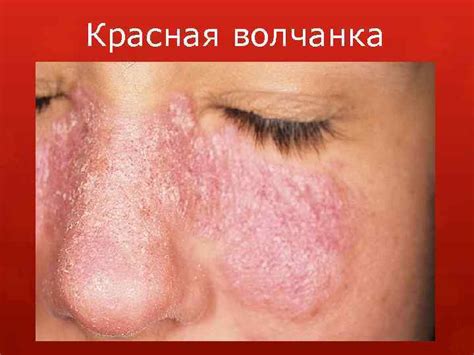 Красная волчанка - причины возникновения, симптомы - Паразиты и грибки ...