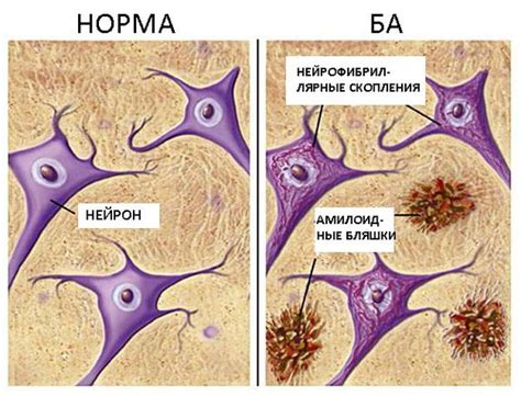 Деменция: что это, симптомы, признаки и стадии болезни в статье ...