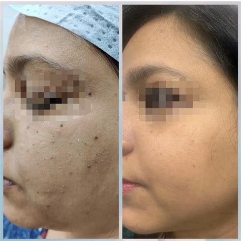 Skin Tags Removal Cases - Dr. Soni Rathore