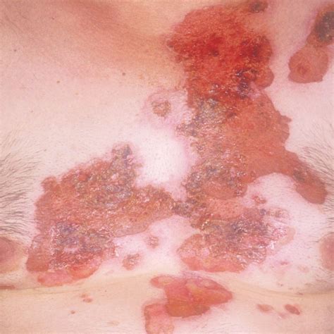 pemphigus  skin clinic  gurgaon