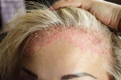 O Que É Dermatite Seborreica - Dermatite: o que é, tipos, sintomas, causas e tratamentos