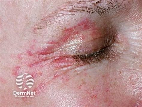 Periocular dermatitis (Periorbital dermatitis): Symptoms with Images ...