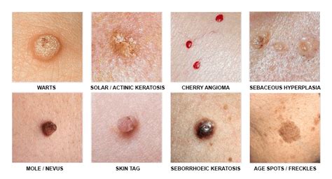 Cryotherapy (lesion removal) - Skinfocus