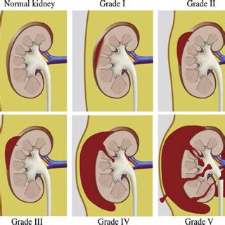 Scheme of AAST renal injury grading scale. | Download Scientific Diagram