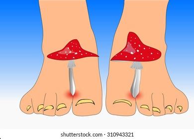 Fungus Between Toes Photos, Images & Pictures | Shutterstock