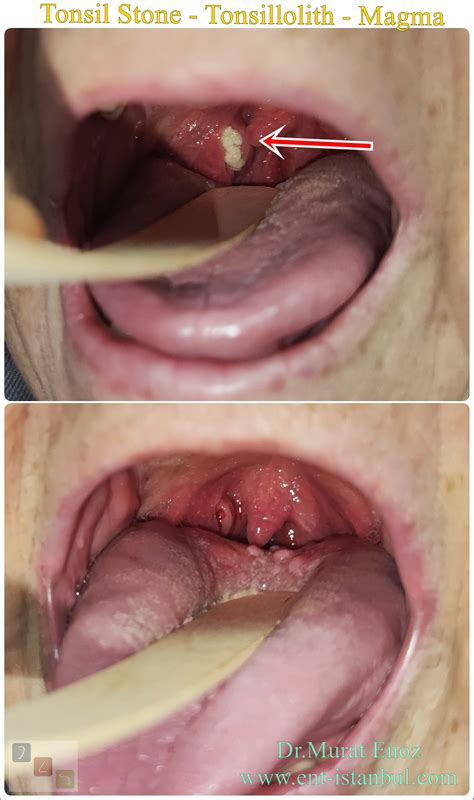 tonsil stone definition symptoms  treatment