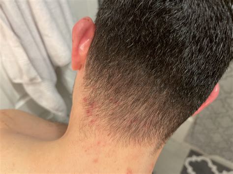 Heat Rash Back Of Head at Roger Krug blog