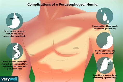Hernia Symptoms And Types