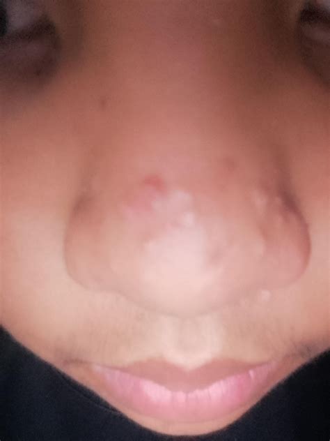 What Are Nose Bumps at Gail Carroll blog