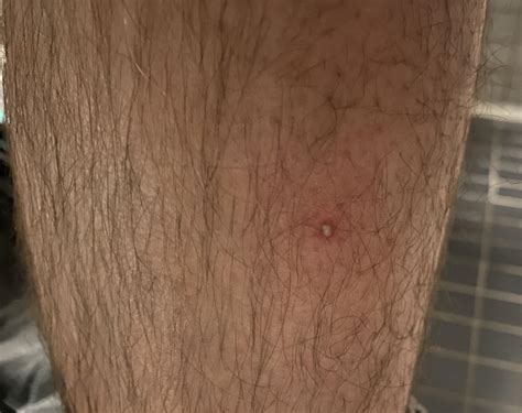 Brown recluse bite? : r/BrownRecluseBites