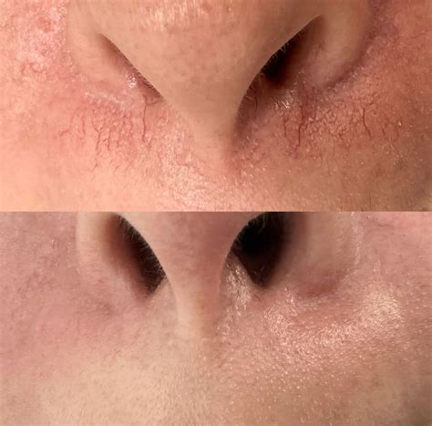 Broken Capillaries & Spider Veins Treatment - Lashes & Lipstick