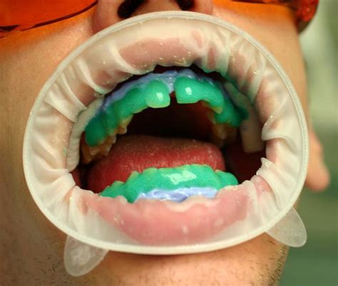BLANQUEAMIENTO DE DIENTES: 10 mitos y verdades | Directorio Odontológico
