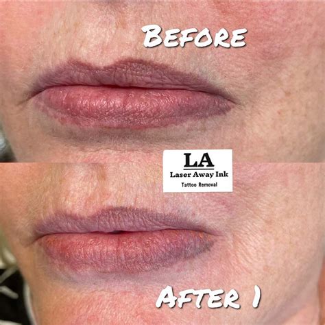 Lip Tattoo Removal - All About Laser & Non-Laser Options