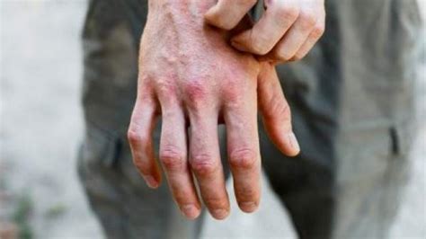 ¿Qué es el eccema dishidrótico? Posibles causas y tratamiento