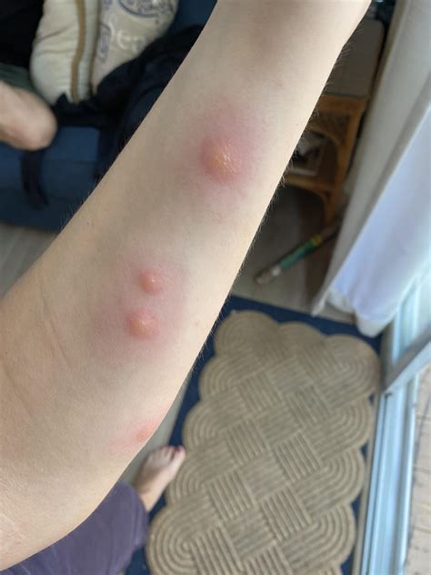 Woke up with this.. red itchy bump on my inner thigh. : r/bugbites